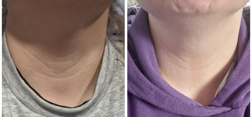 Sylwia - efekt przed i po stosowaniu WOW KOLAGEN, widoczna różnica w skórze szyi i dekoltu